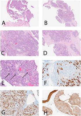 Case report: A rare case of oral sebaceous carcinoma in the upper lip